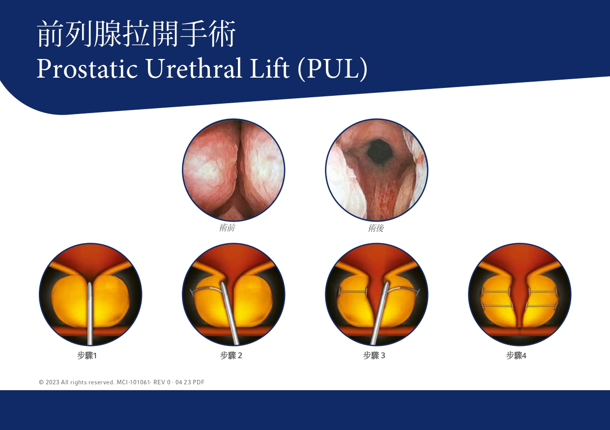 UroLift前列腺拉開術－攝護腺肥大的剋星｜長安醫院