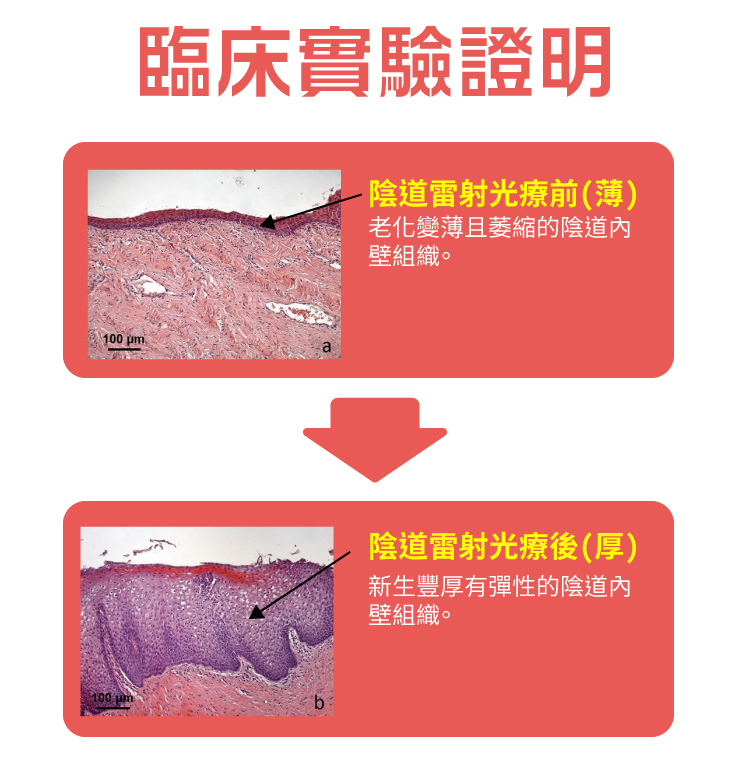 陰道雷射治療-蒙娜麗莎之吻|長安醫院 陰道雷射治療-蒙娜麗莎之吻|長安醫院