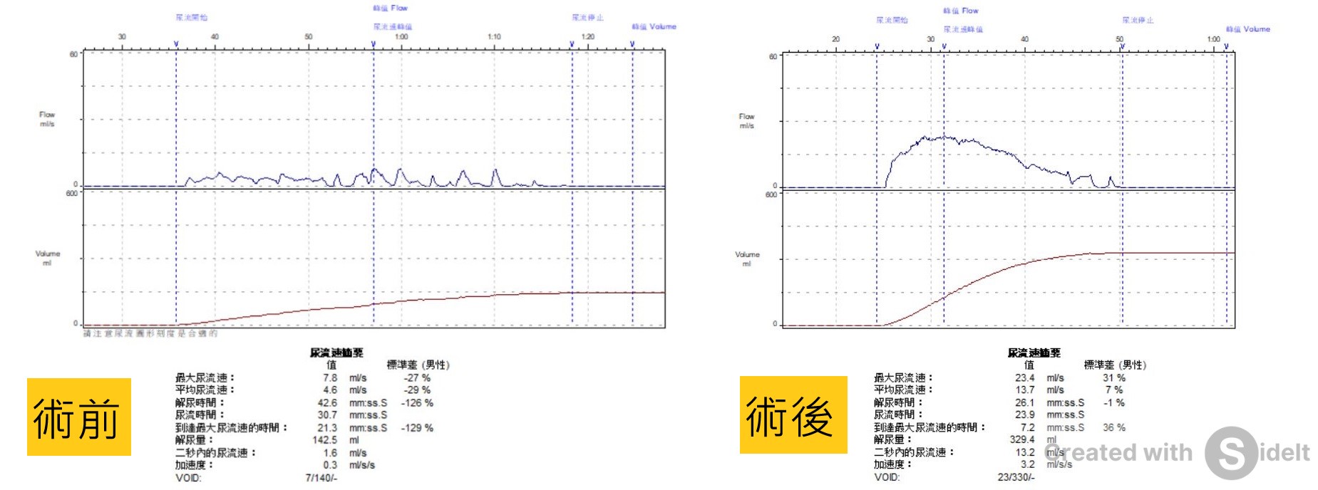 UroLift前列腺拉開術－攝護腺肥大的剋星｜長安醫院