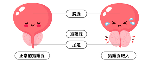 UroLift前列腺拉開術－攝護腺肥大的剋星｜長安醫院