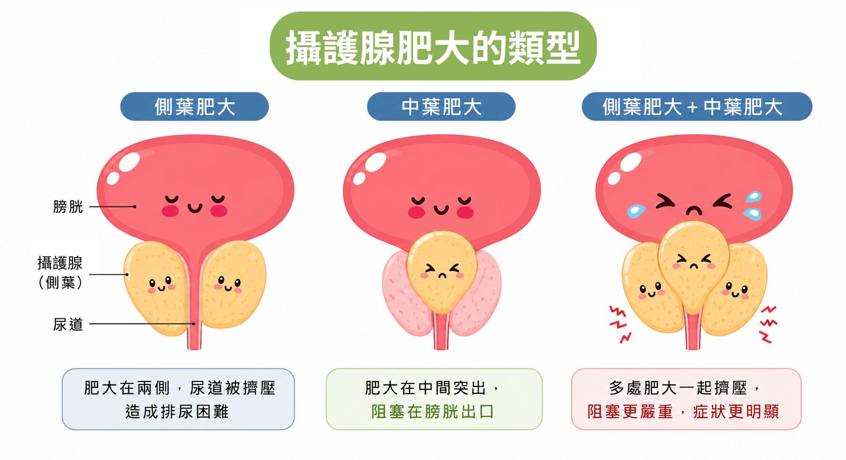 攝護腺肥大治療:告別排尿困擾,重拾順暢人生|長安醫院泌尿科 攝護腺肥大治療:告別排尿困擾,重拾順暢人生|長安醫院泌尿科